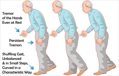 Dr. Ayati an expert in Parkinson's disease